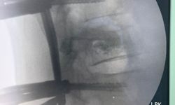 Trabzon'da omurga vidalama ameliyatı geçiren hasta sağlığına kavuştu